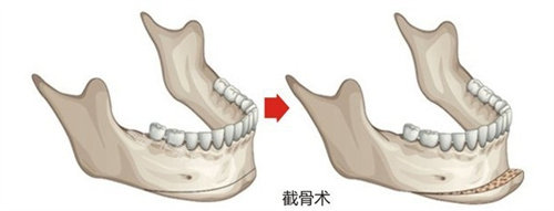 下巴截骨手術(shù)動畫圖