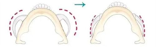 下頜角截骨動(dòng)畫(huà)圖 下頜角截骨動(dòng)畫(huà)圖