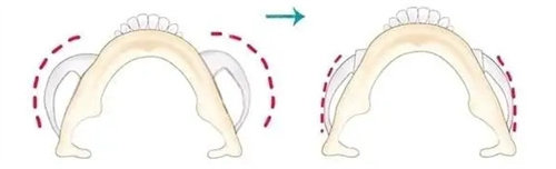 下颌角截骨动画图