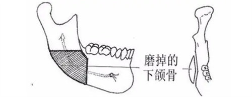 磨掉的下頜角 磨掉的下頜角