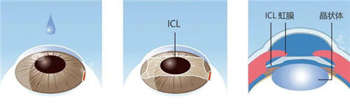 晶体植入手术细节图