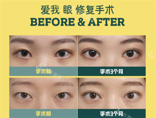 韓國愛我整形外科眼修復(fù)手術(shù)對(duì)比照