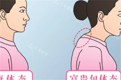 富貴包的體態(tài) 富貴包的體態(tài)