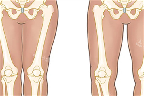 正常腿型和O型腿的区别