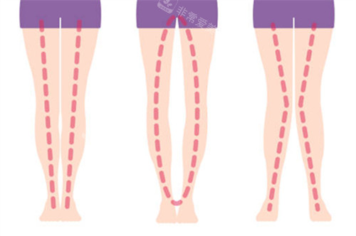 不同腿部形態(tài)的區(qū)別