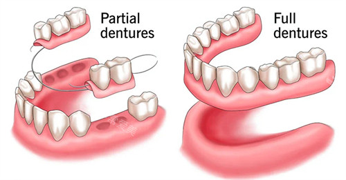 修补缺失的牙齿