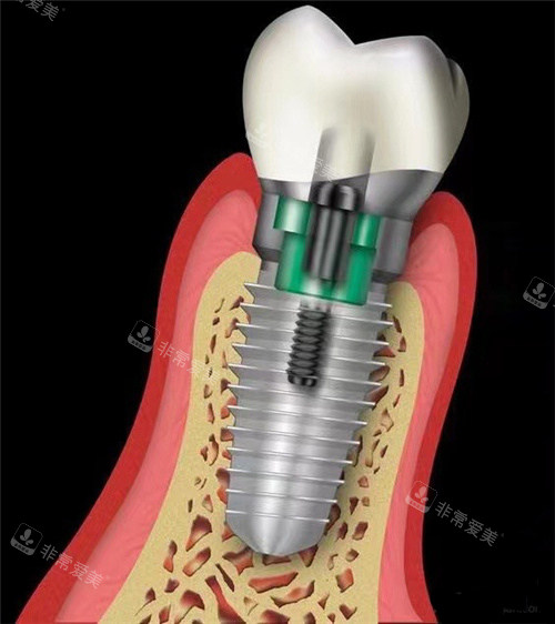 种植牙结构图示