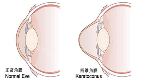 正常眼睛和圆锥角膜眼睛的不同
