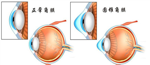 正阳角膜和圆锥角膜结构不同