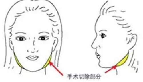 下颌手术切除部分