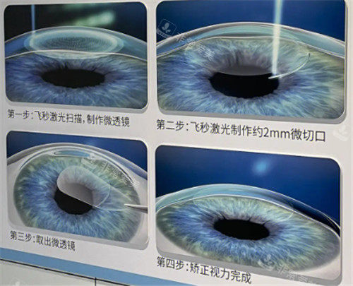 近视眼激光手术细节图