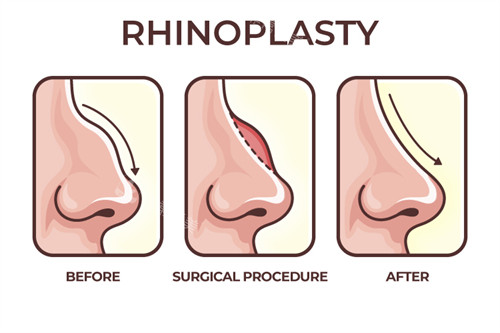 隆鼻手术过程