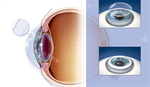 人工角膜手术过程