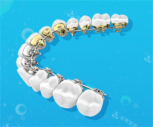 舌側(cè)矯正細(xì)節(jié)圖 舌側(cè)矯正細(xì)節(jié)圖