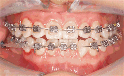 牙齒矯正細節(jié)圖