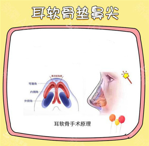 耳软骨隆鼻图示