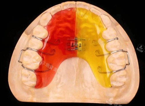 牙齿扩弓治疗细节图