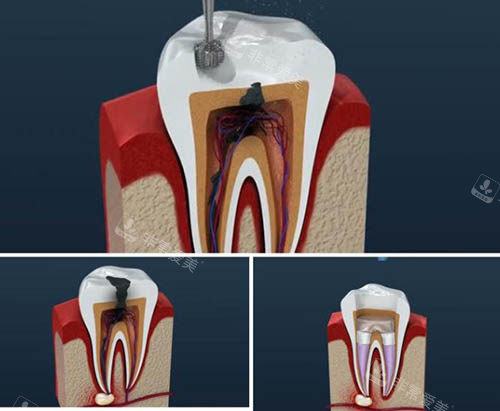 根管治疗模拟图