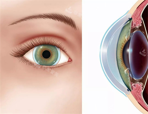 圆锥角膜患者眼睛的外观