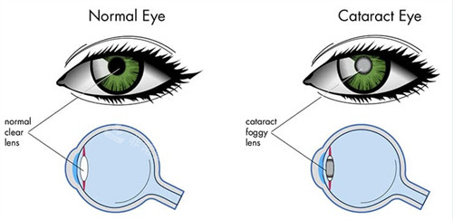 白内障眼睛和正常眼睛的对比图