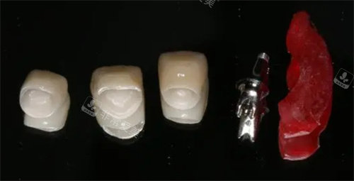 種植牙零件組成圖
