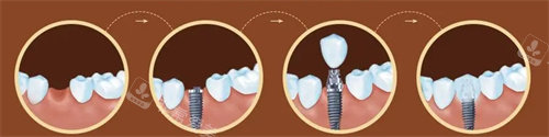 种植牙流程图