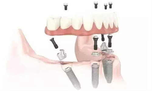 全口种植牙动画图