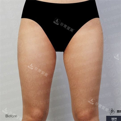 韩国PetitParty整形腿部吸脂术前图
