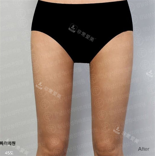 韩国PetitParty整形腿部吸脂术后图