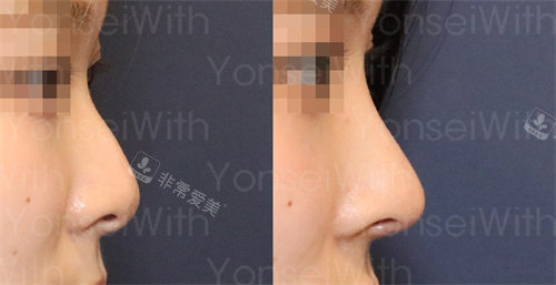 韩国延世white耳鼻喉科隆鼻侧面对比图