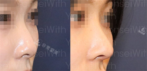 韓國延世white耳鼻喉科隆鼻側(cè)面對(duì)比圖