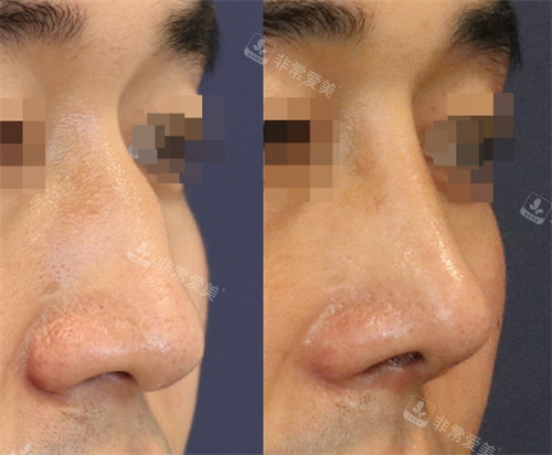 韩国延世white耳鼻喉科做的驼峰鼻矫正侧面对比图
