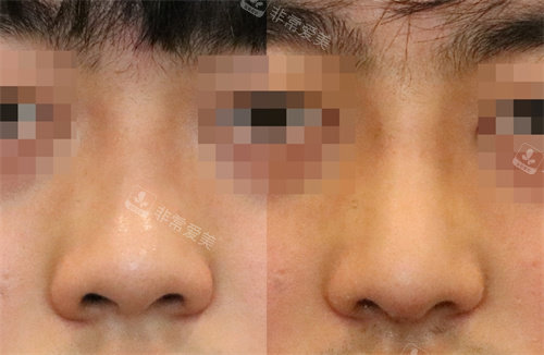 韩国延世white耳鼻喉科隆鼻对比图