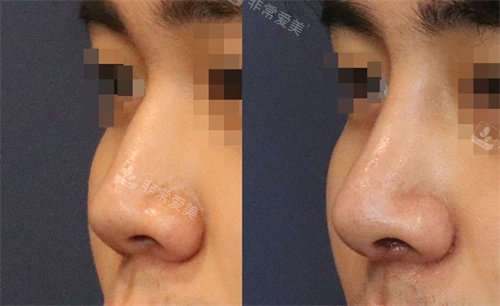 韩国延世white耳鼻喉科鼻部矫正手术对比图