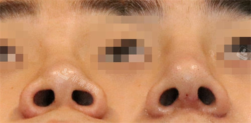 韩国延世white耳鼻喉科鼻部矫正手术对比图