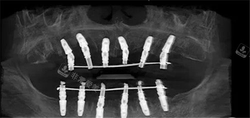 全口种植牙ct照片