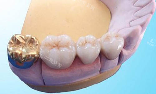 牙冠修复图片