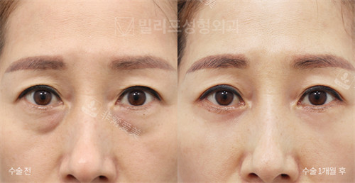 韩国V.LIF比丽普整形外科改善眼袋泪沟前后对比图