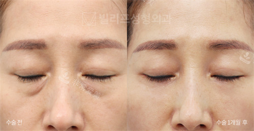 韩国V.LIF比丽普整形外科改善眼袋泪沟前后对比图闭眼