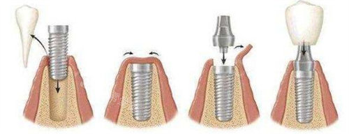 种植牙流程图