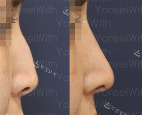 改善鼻子形态前后对比图