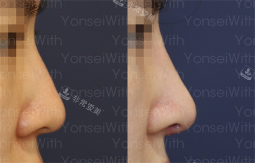 韩国延世white耳鼻喉科鼻矫正前后对比图
