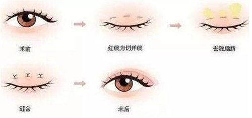 雙眼皮手術(shù)流程圖 雙眼皮手術(shù)流程圖