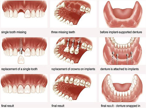 对缺损牙齿进行种植修复