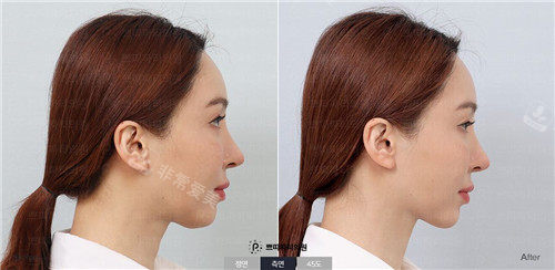 韩国petitparty整形面部提升手术图片