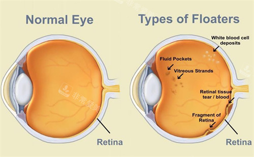 飞蚊症患者眼睛结构