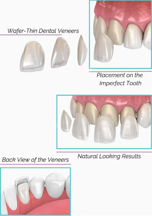 牙齿可以改善牙齿颜色也能修补缺损牙齿