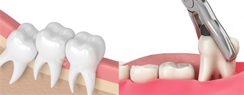 拔除影响其他牙齿生长的牙