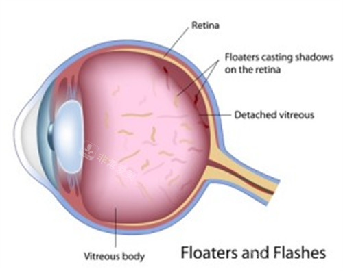 飞蚊症患者的玻璃体