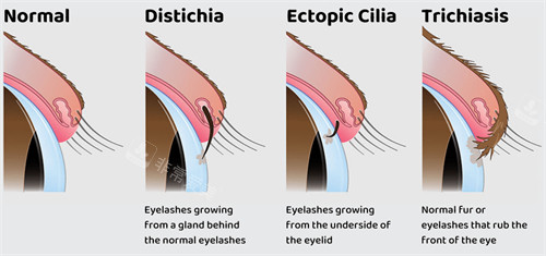 正常的睫毛和倒睫